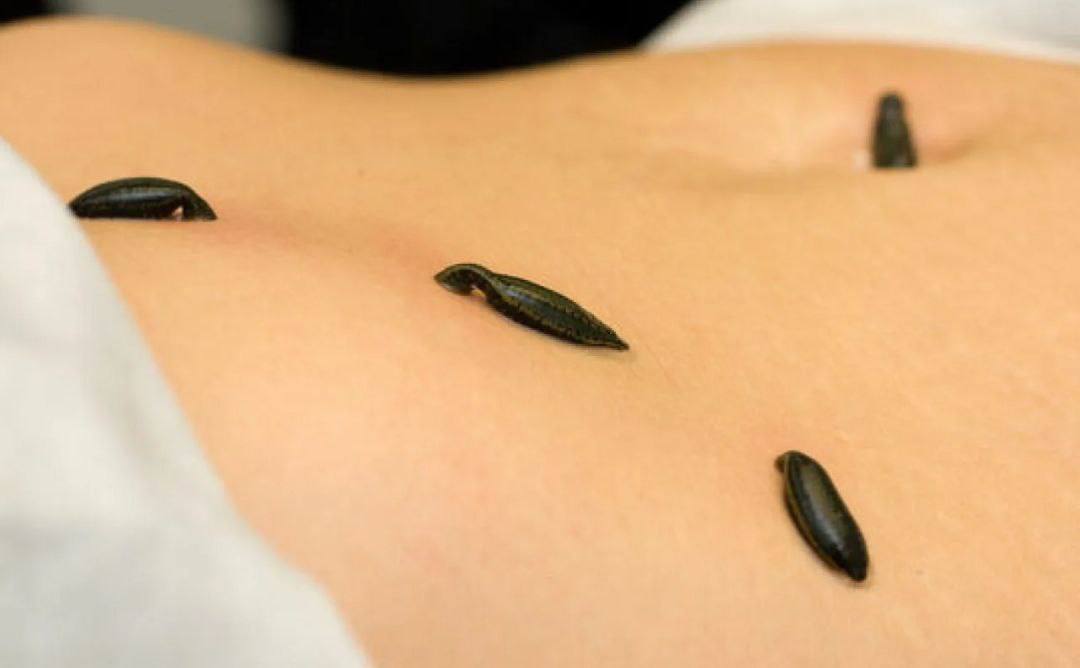 Процедура гирудотерапии